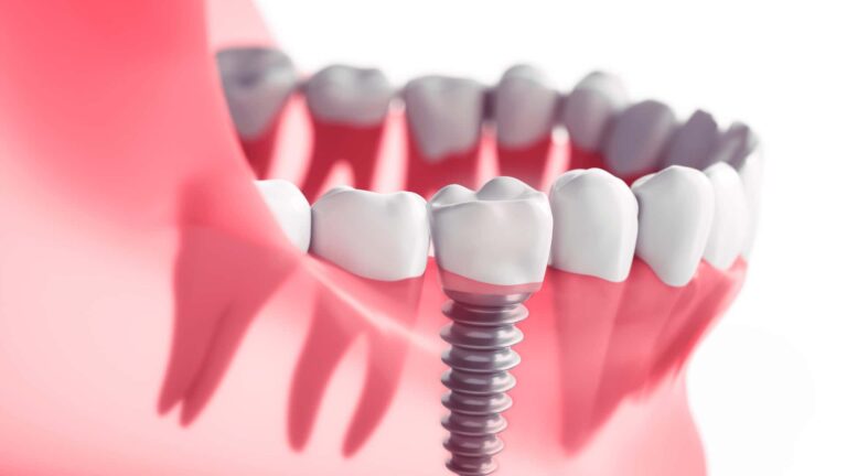 Dental Implants