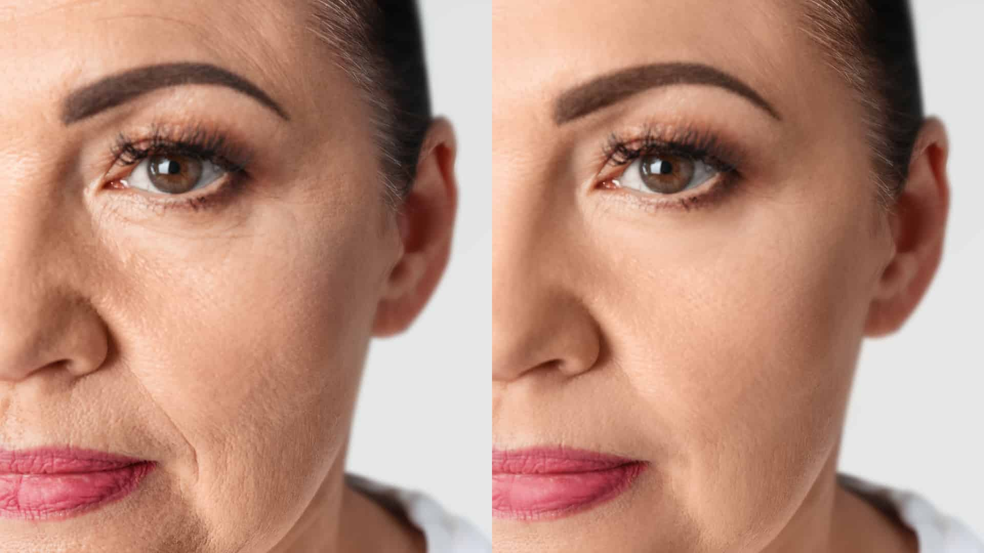 Non-Surgical Face Lifts